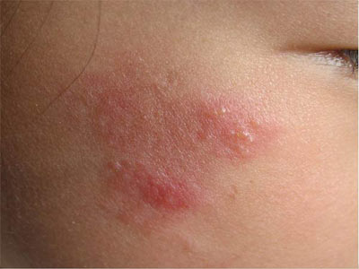 带状疱疹的症状是什么样的